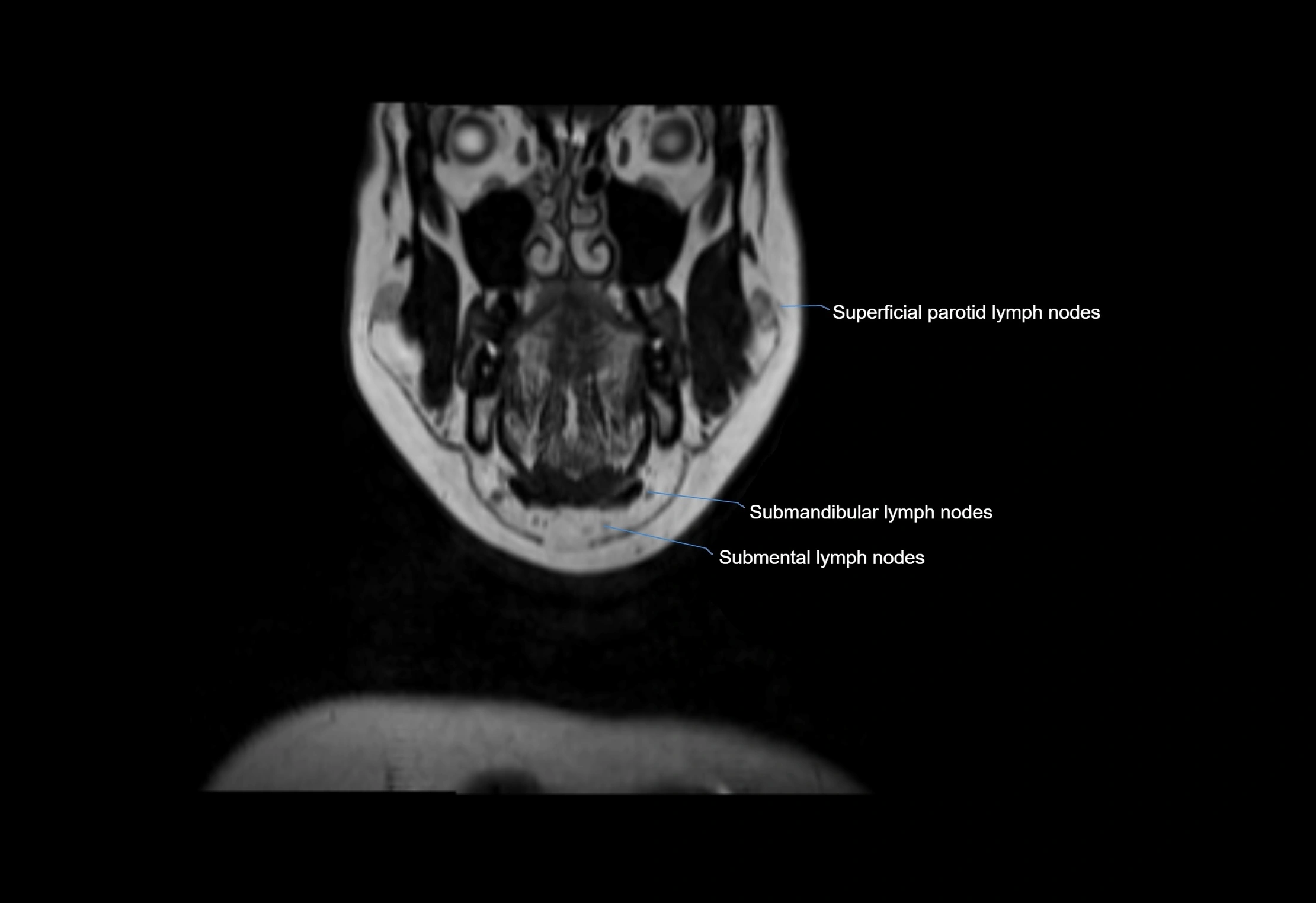 Neck coronal lymph node cross sectional MRI anatomy 3T MRI  image-img-00001-00060.webp